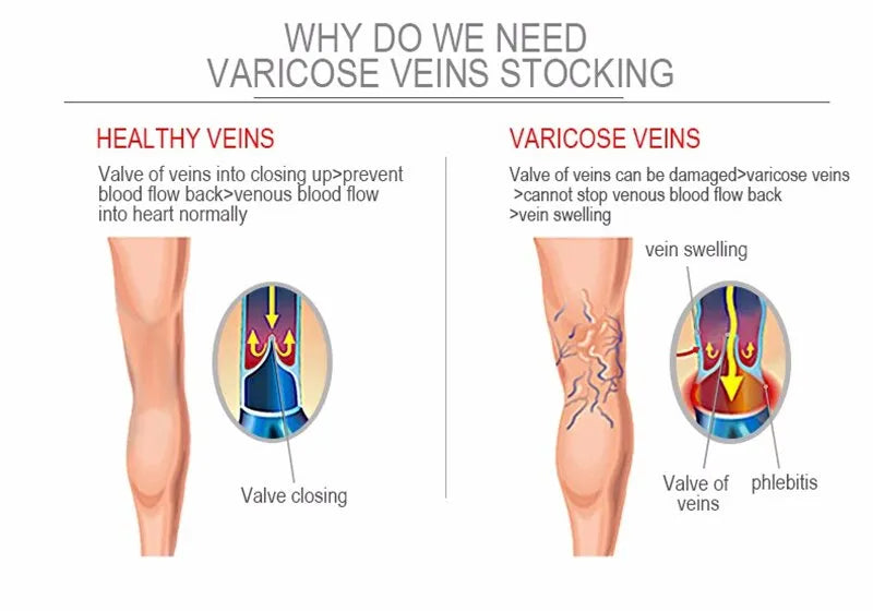Compression Stockings for Better Blood Circulation