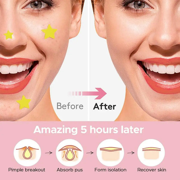 "600 Fun Star-Shaped Acne Patches – Gentle & Colorful Skincare for Teens"